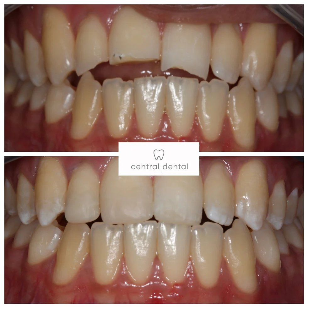 Composite Bonding