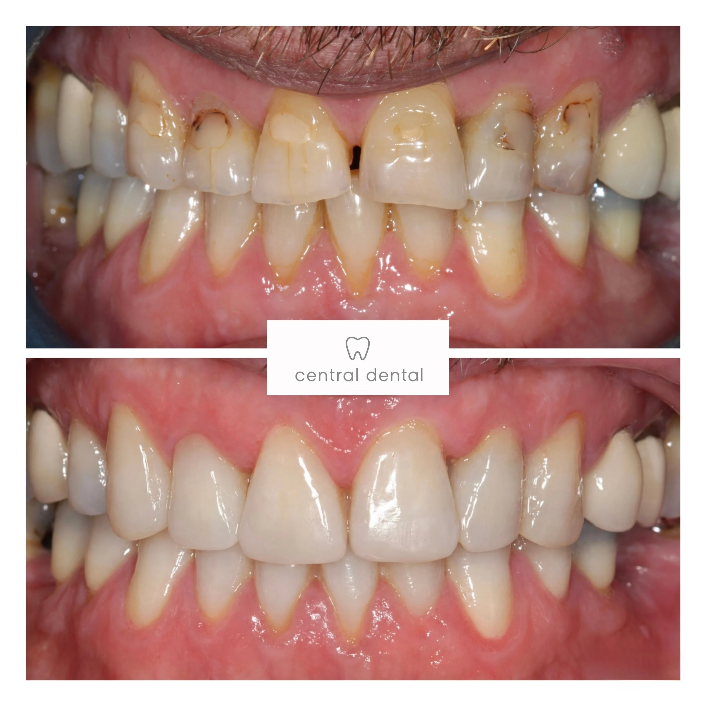 Composite bonding