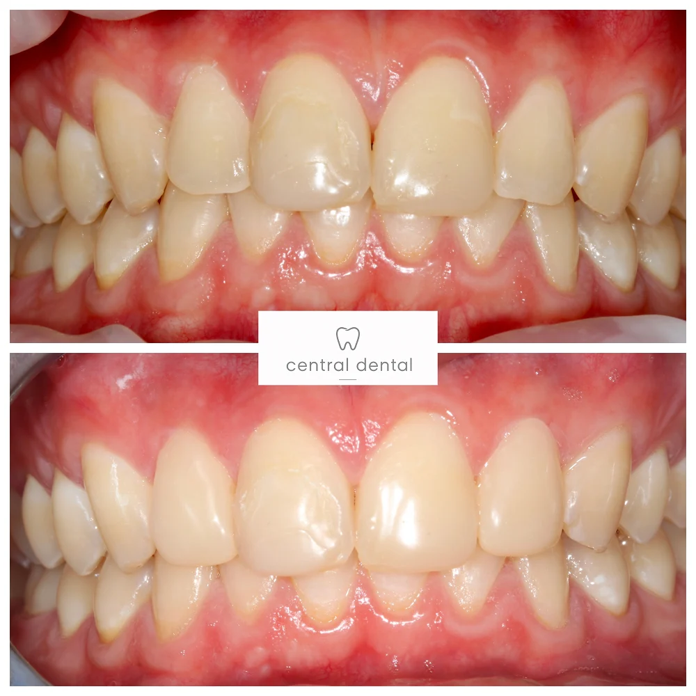 Composite bonding