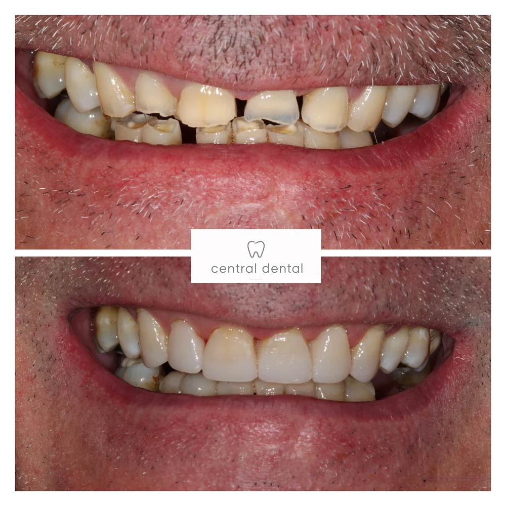 Composite management of toothwear