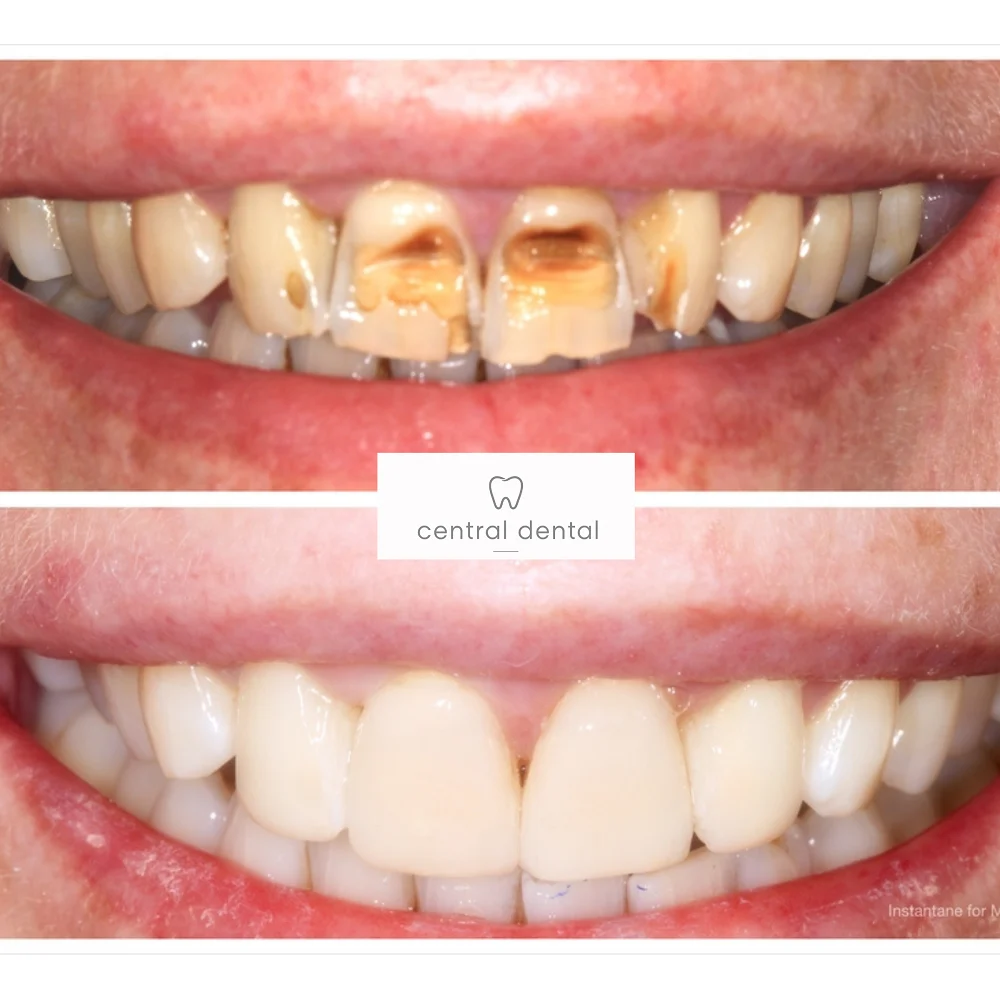 Composite veneers