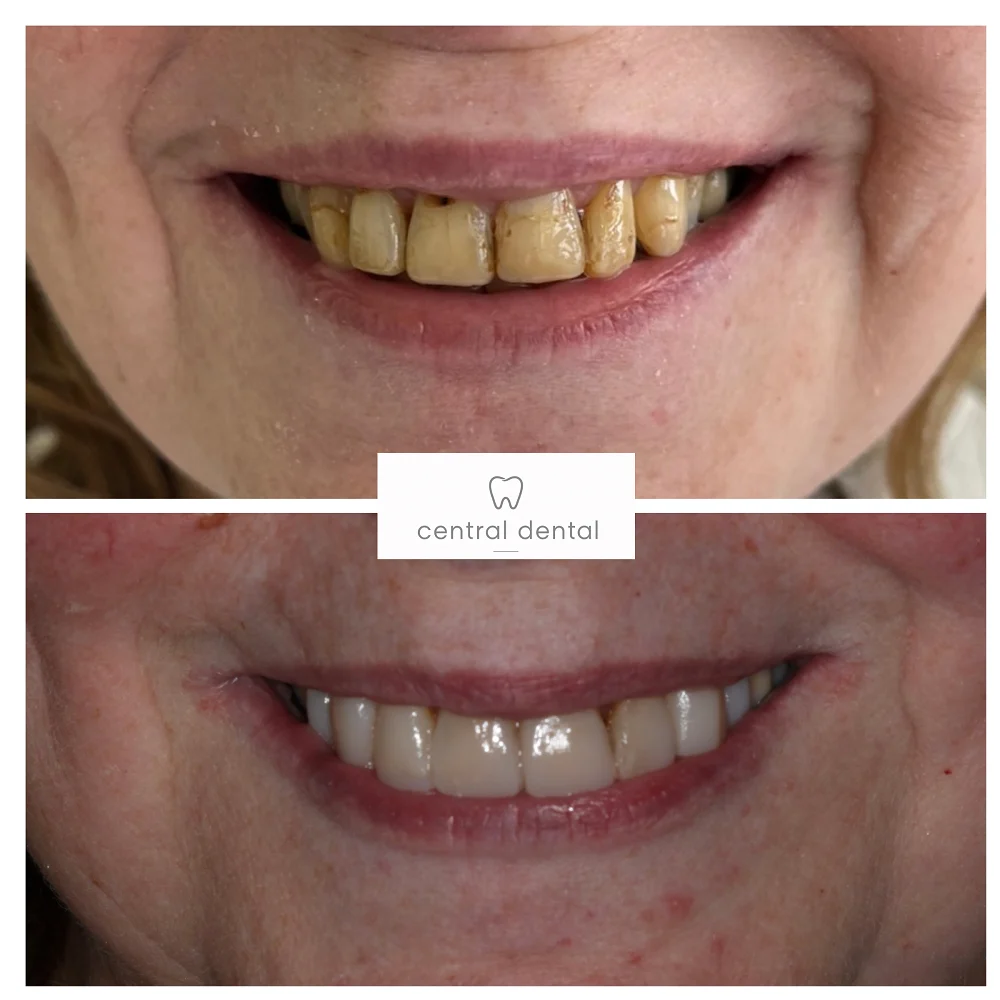Composite veneers