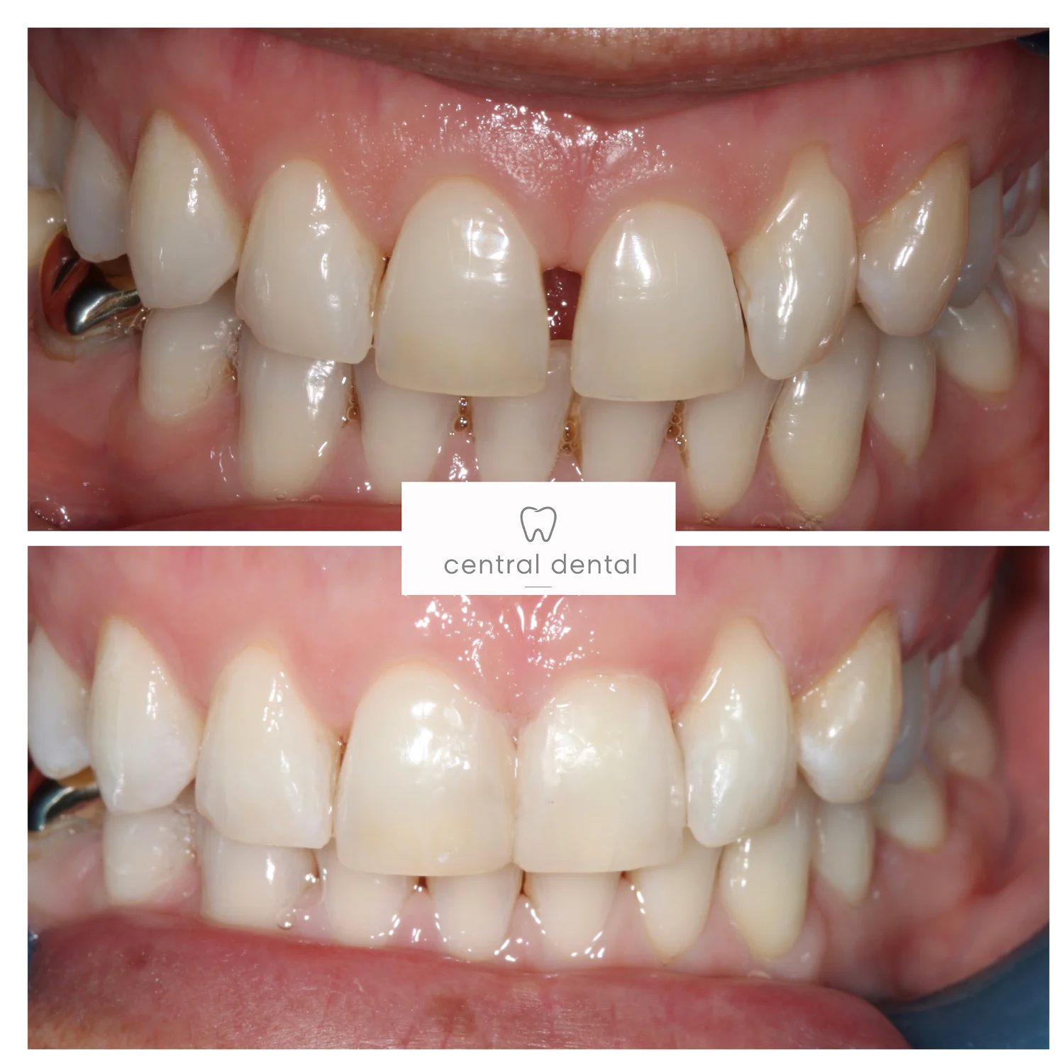 Invisalign