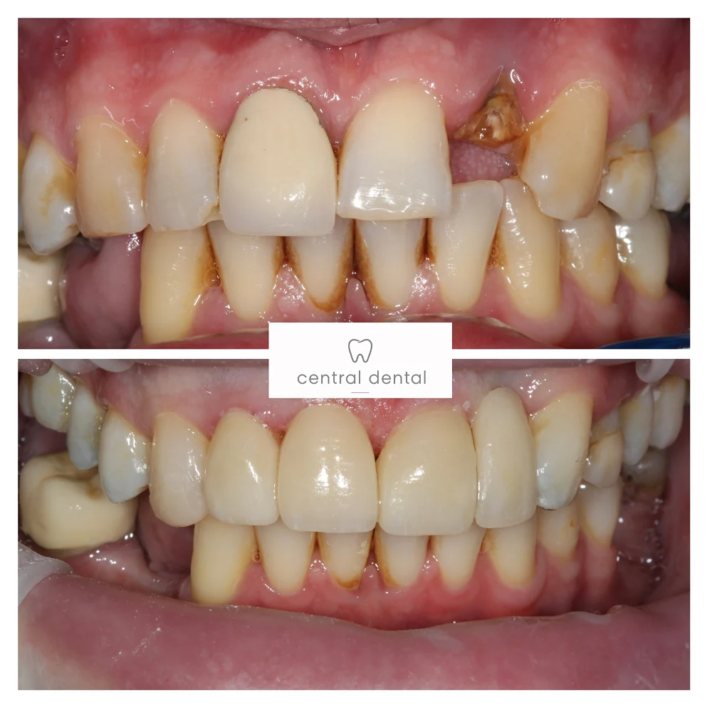Porcelain Veneers
