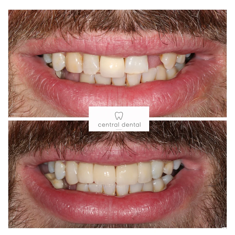 Porcelain Veneers