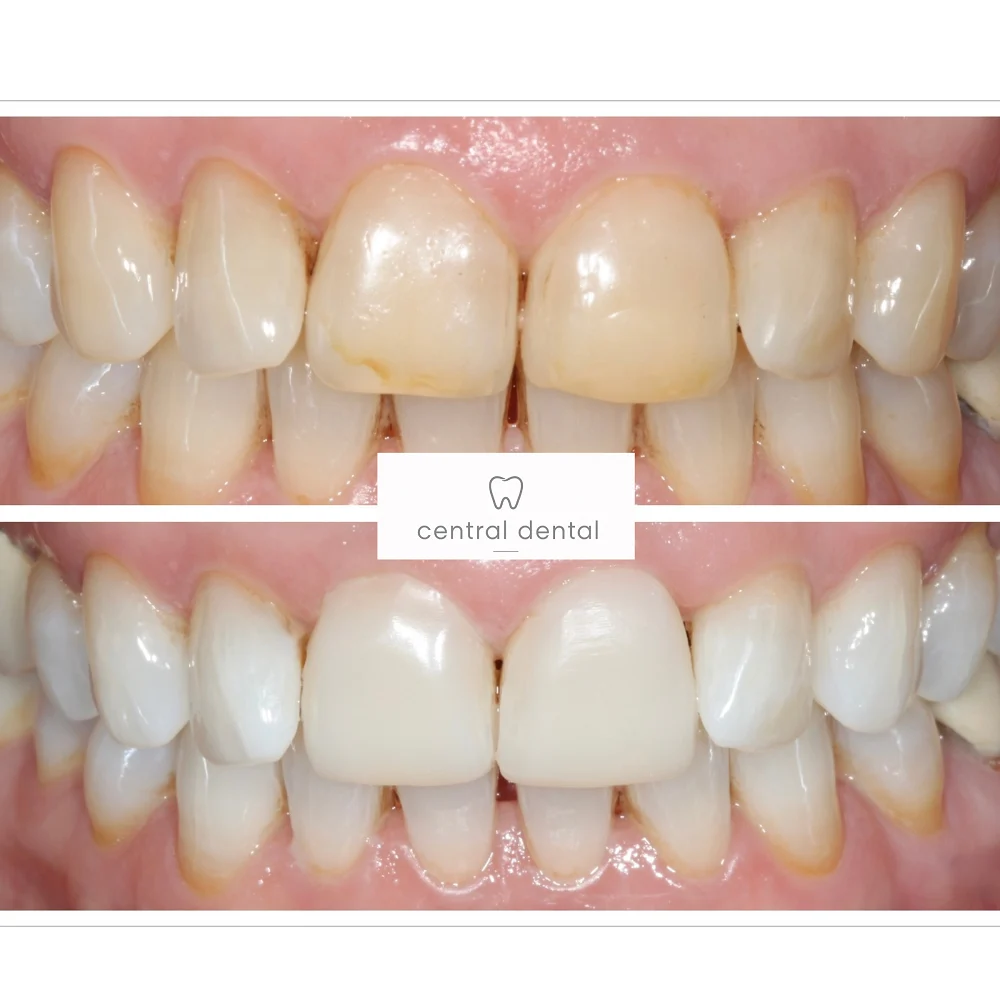 Whitening and composite bonding