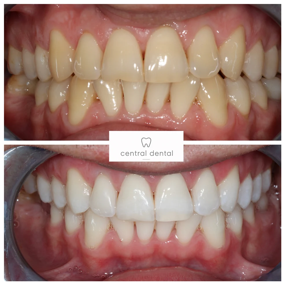 Whitening and composite bonding