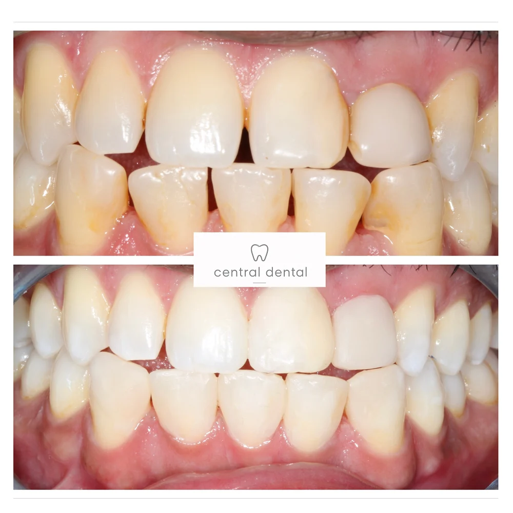 Whitening and composite gap closure