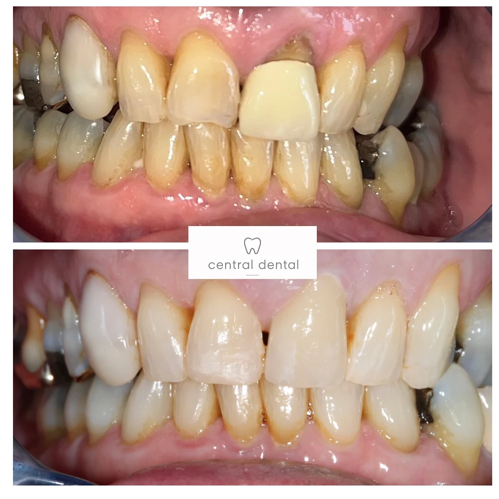 Whitening and crown replacement