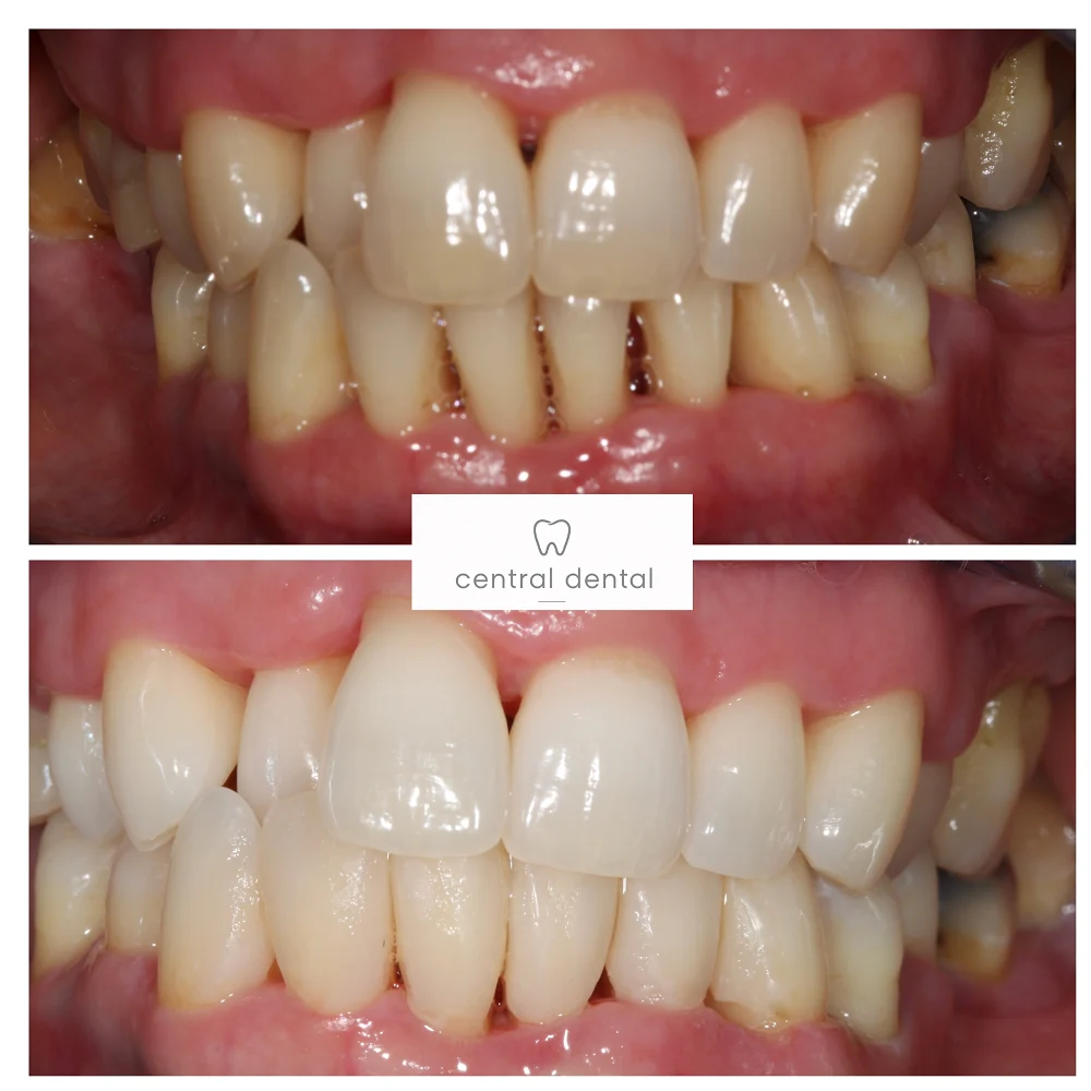 Whitening and gap closure with composite